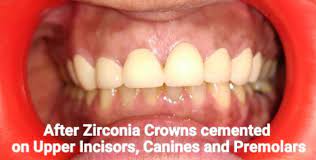 Zirconia Crowns